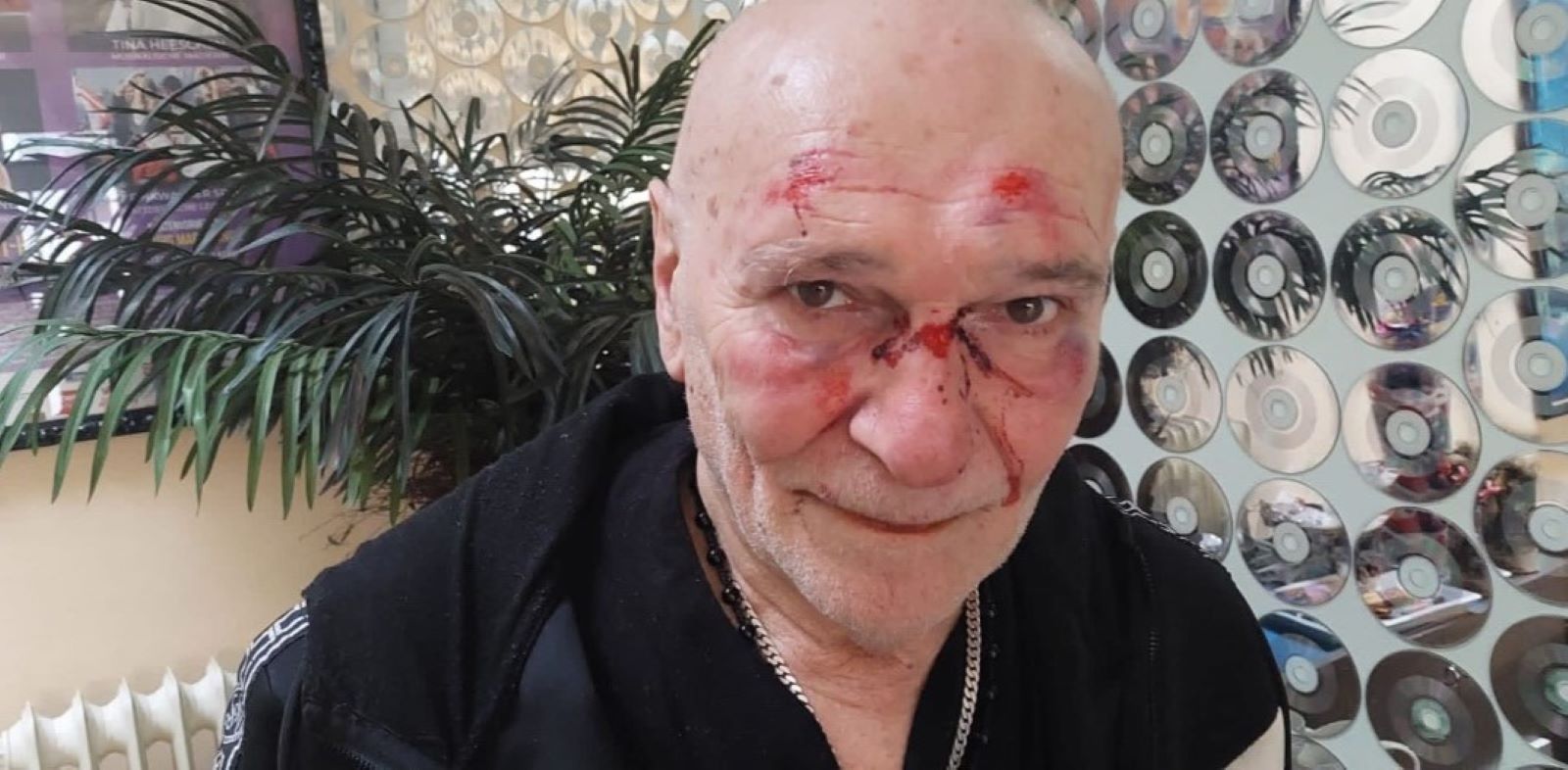 Schwer gezeichnet: Sänger Peter Sebastian erlitt Platzwunden und Prellungen im Gesicht. Foto: privat